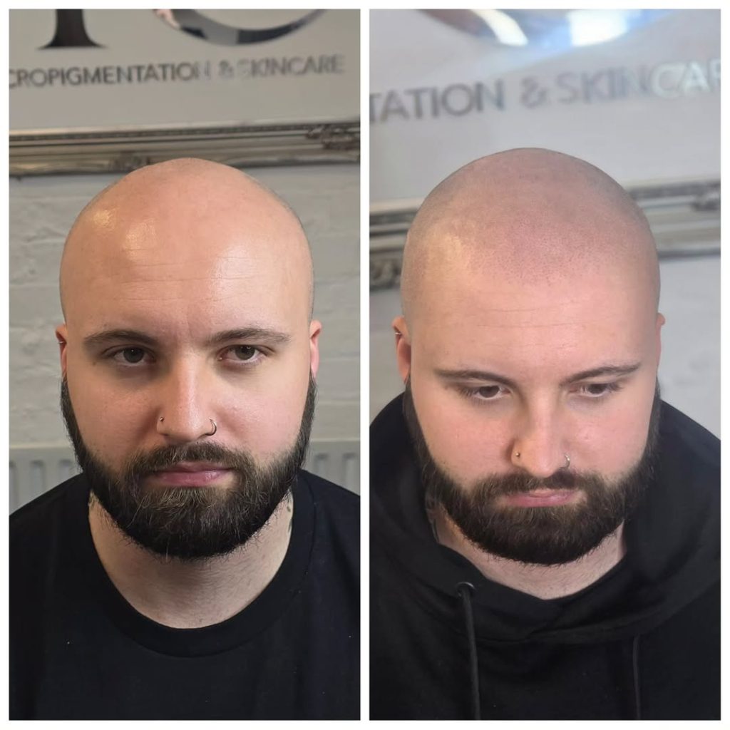 Before and after scalp micropigmentation for men showing fuller hairline and improved definition at mc scalp hemel hempstead
