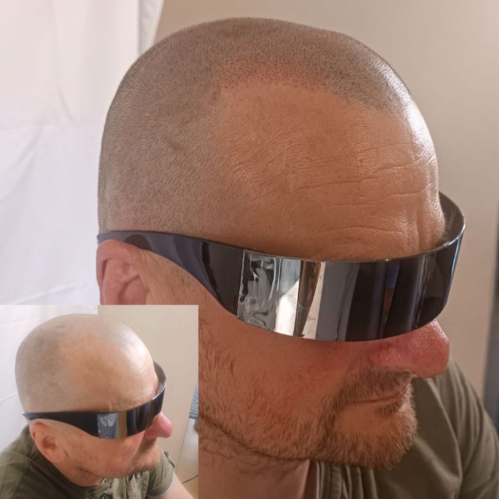 Close-up of male smp treatment with realistic shaved hair follicle effect by mc scalp hemel hempstead