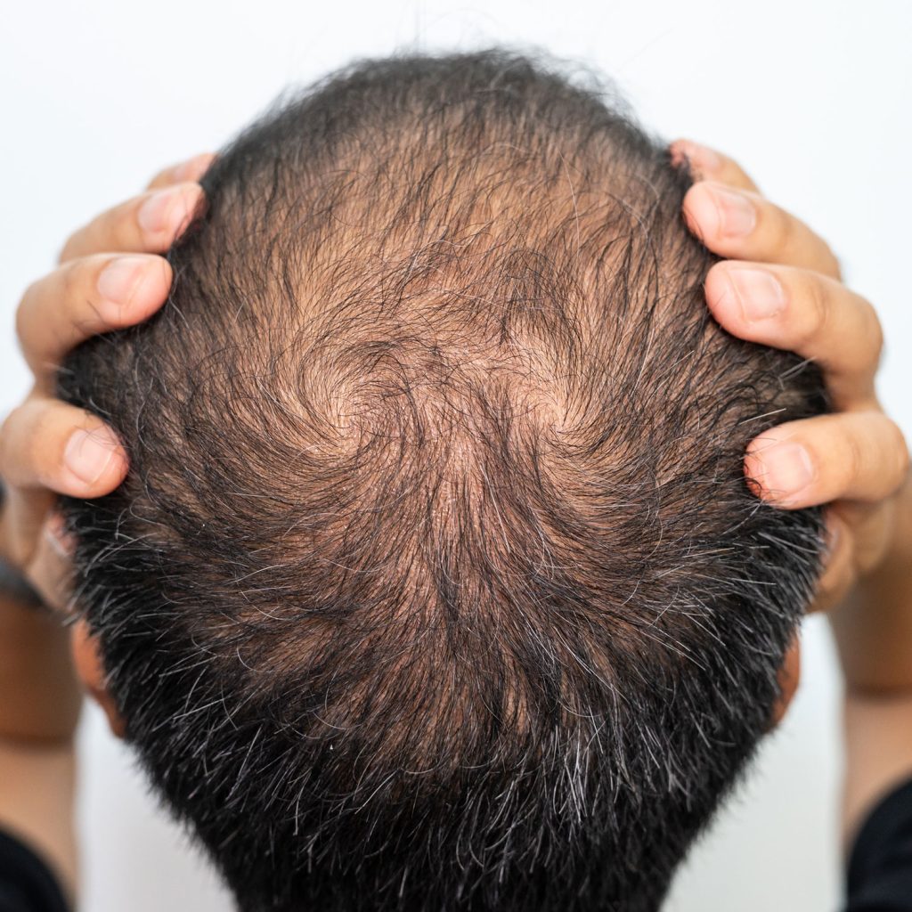 Before and after density treatment showing thicker-looking hair with smp at mc scalp hemel hempstead