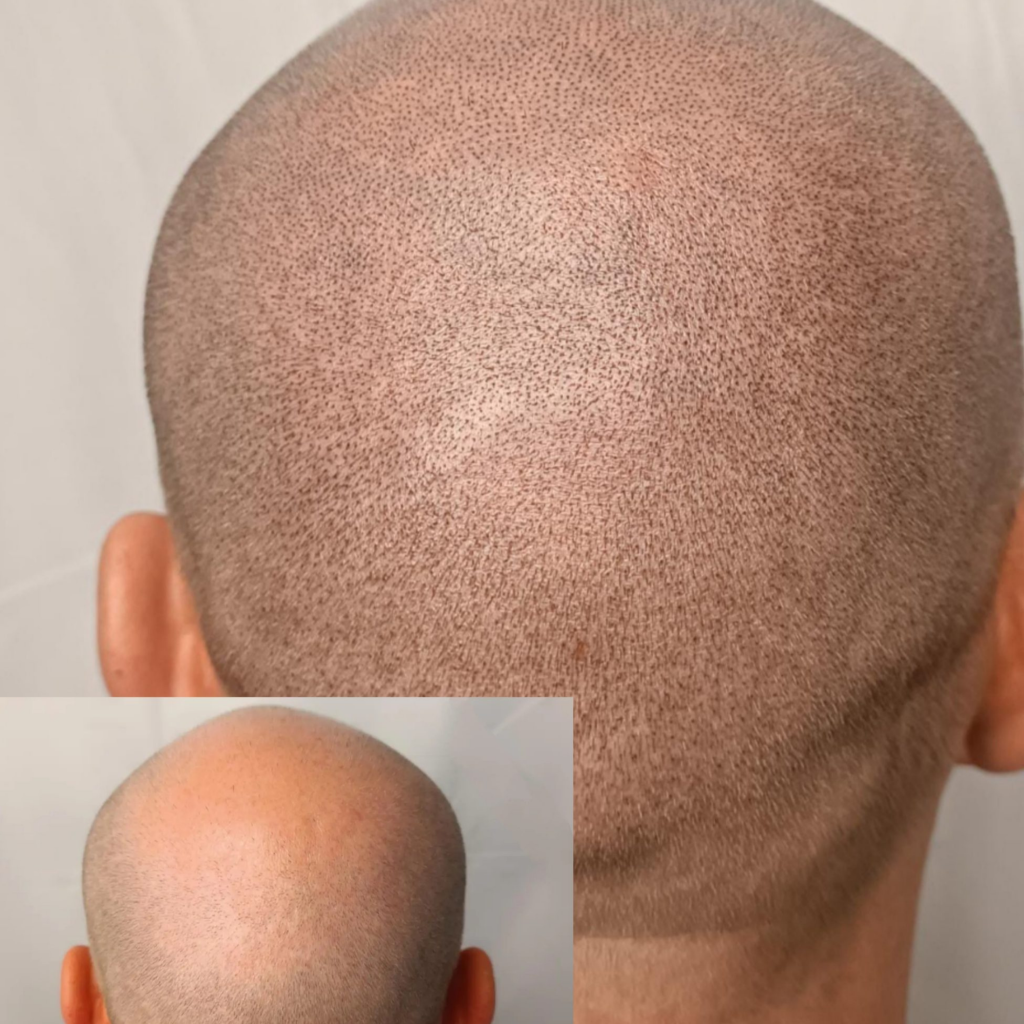 Men’s scalp micropigmentation creating a defined shaved hairline at mc scalp hemel hempstead