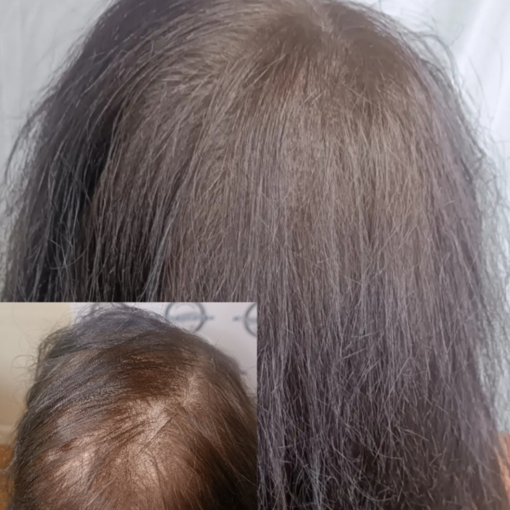 Scalp micropigmentation for women improving hair density and scalp coverage at mc scalp hemel hempstead