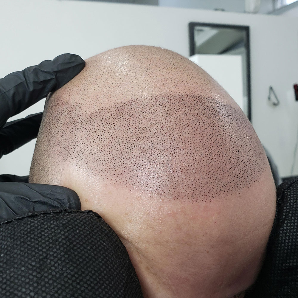 Close-up of realistic smp results showing detailed hairline work by mc scalp hemel hempstead